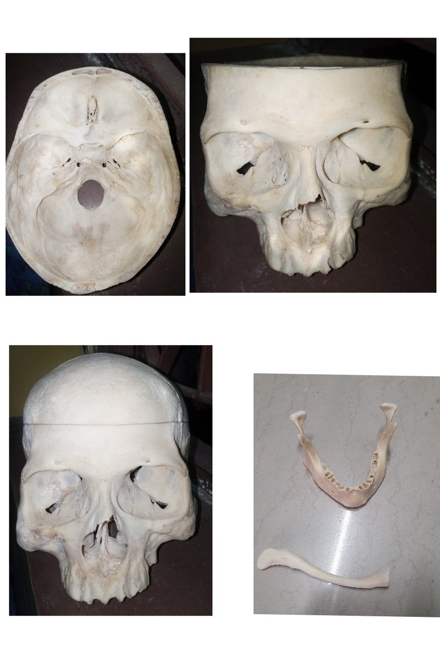 Complete Bilateral Boneset