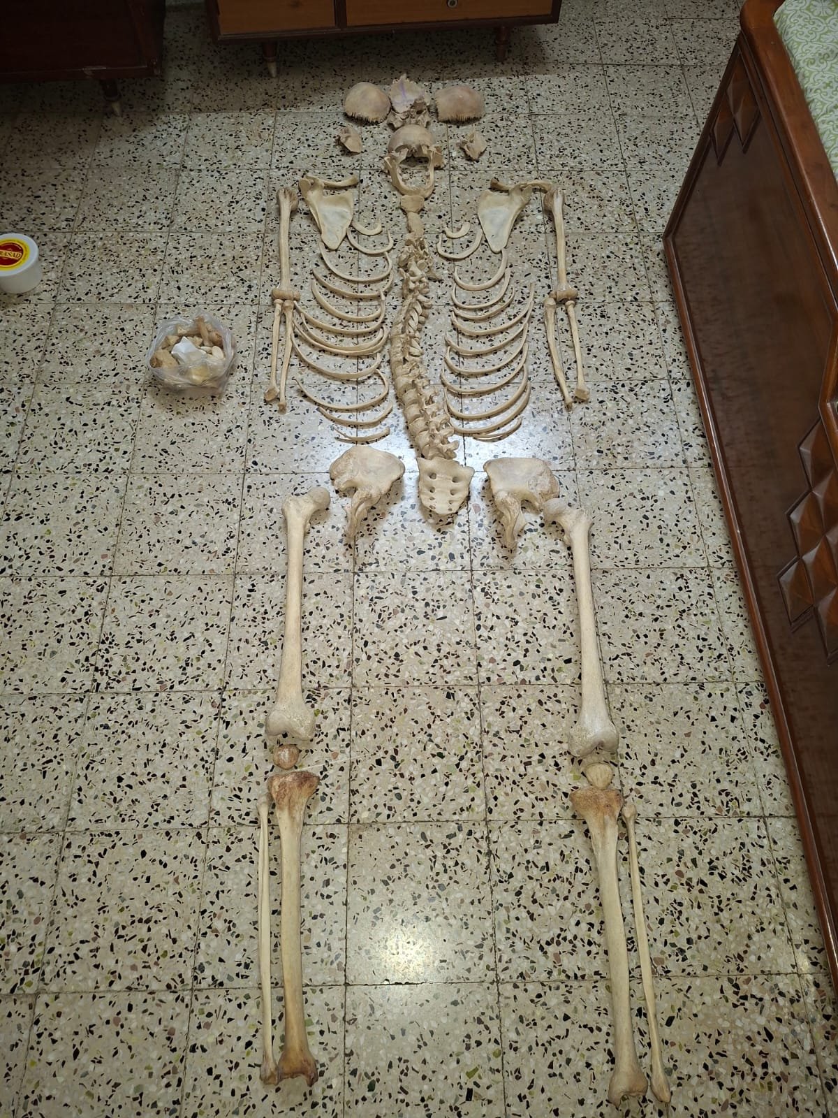 Complete Bilateral boneset with all bones present, individual skull bones with mandible. First hand. FIRST used by me.
