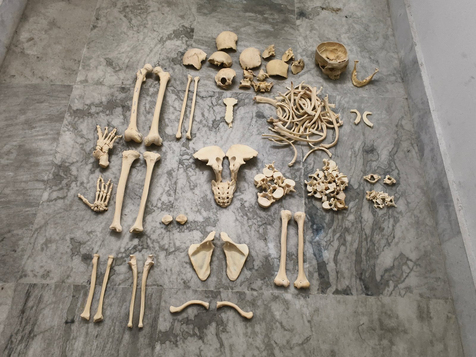 Complete Bilateral Boneset (1st hand)