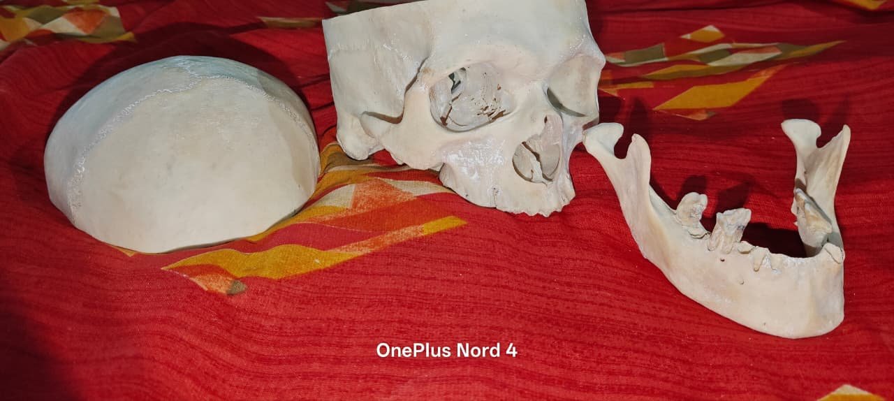 Complete Bilateral Boneset