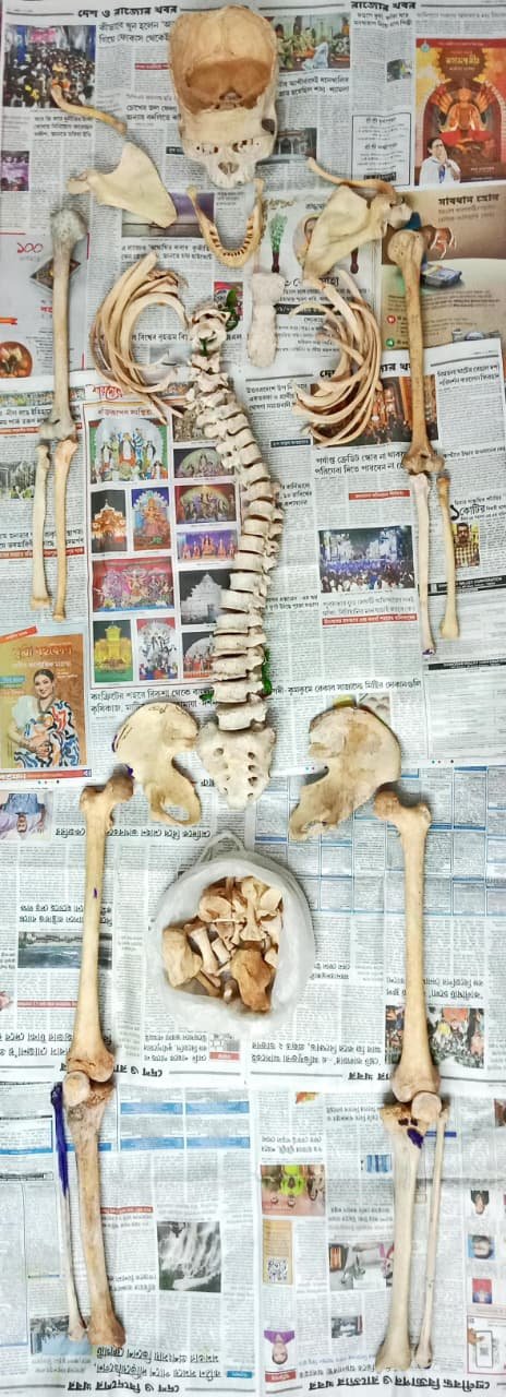 Complete biletaral boneset new condition