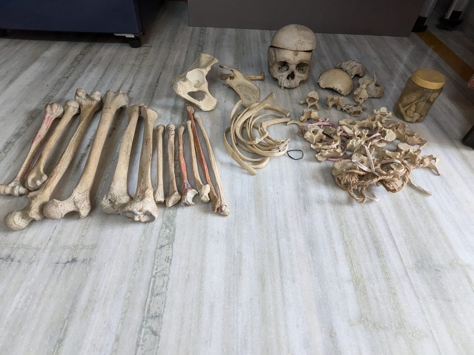 Bilateral Boneset with Base of Skull