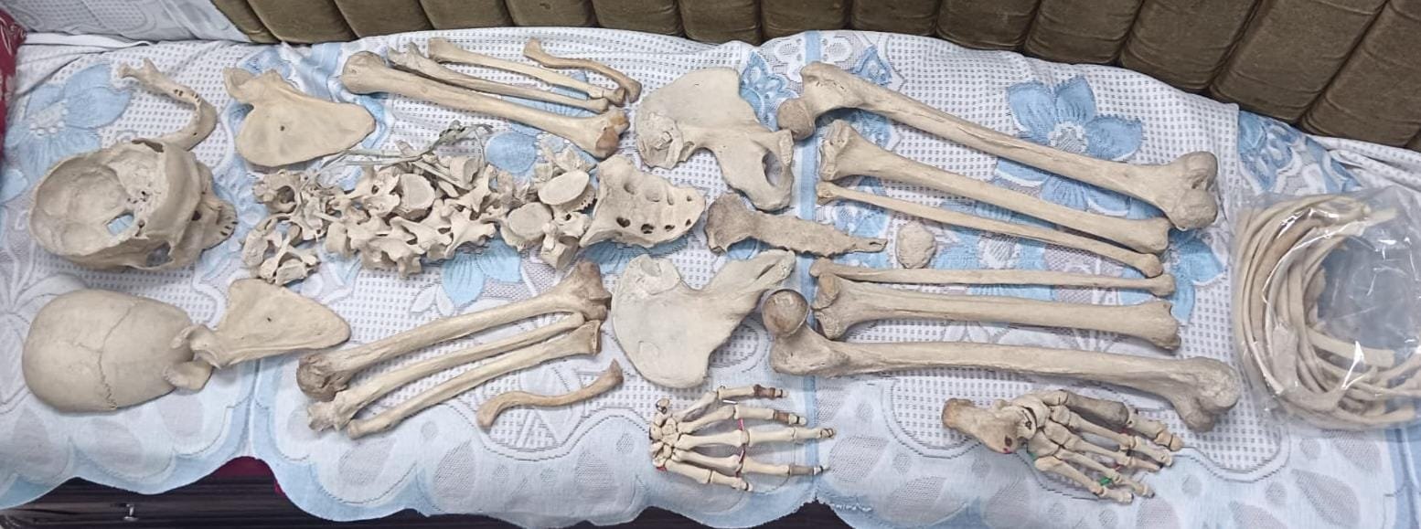 Complete Bilateral Boneset