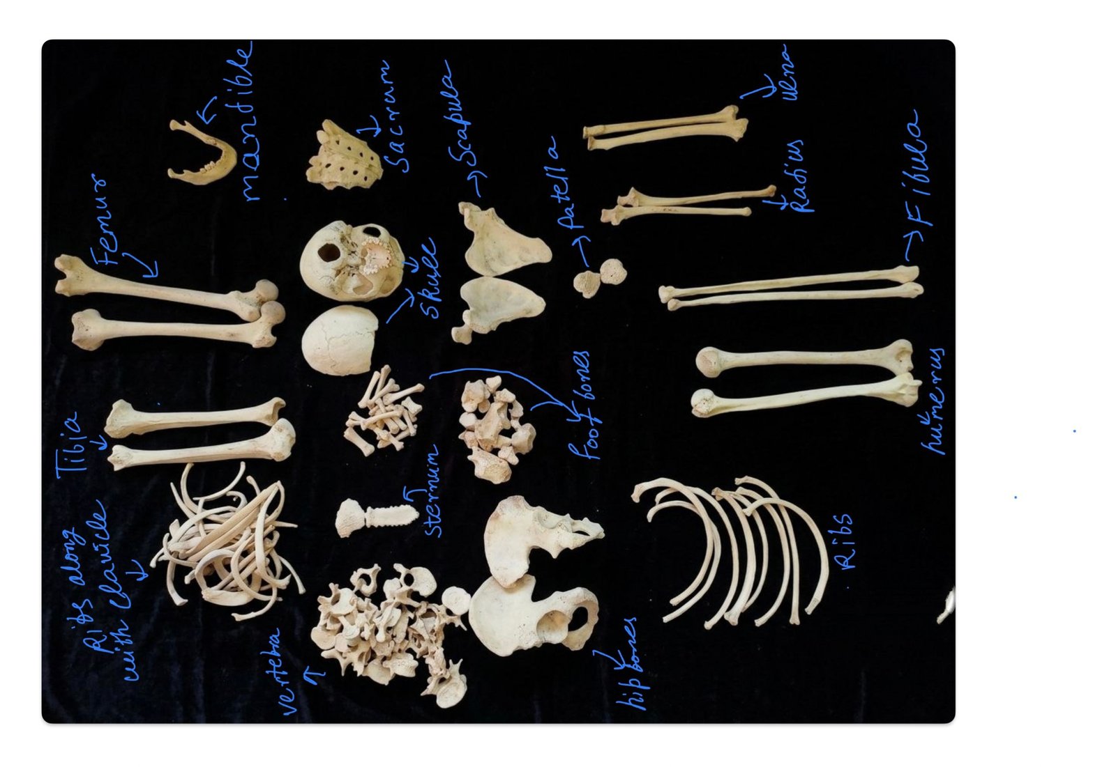 Complete bilateral bone set